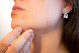 pimple marks cure try these 5 easy