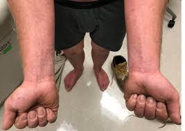 Itching on hands and feet can be quite irritating especially if it distracts our concentration while performing our daily activities. What Is This Construction Worker S Spreading Itchy Rash Consultant360