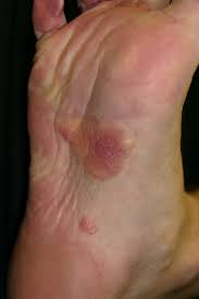 systemic amyloidosis with cutaneous