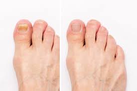 kansas toenail fungus experts