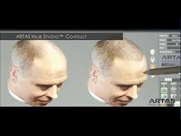 What makes our artas™ hair transplant so unique? Artas Hair Transplant Tampa Hair Restoration Florida Robotic Hair Transplant Tampa