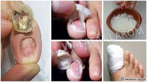 do you suffer from nail fungus you