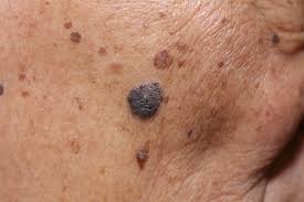 Skin cancer is becoming more and more common, if you're worried about getting skin cancer, check out these 20 skin cancer symptoms everyone when squamous cell carcinoma doesn't develop into a lump, it appears as more of a reddish patch. What Skin Cancer Looks Like