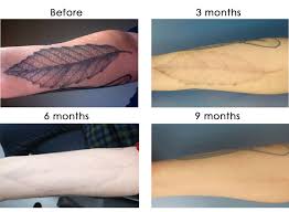 Tattoo removal charges a $200 flat rate per appointment, regardless of how. Laser Tattoo Removal Schweiger Dermatology Group