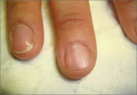 painful nail with longitudinal