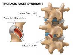 thoracic facet syndrome nj nyc