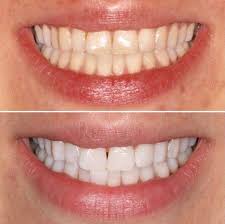 teeth whitening enlighten smiles