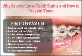 why braces cause teeth stains how to