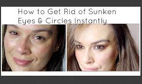 how to get rid of sunken eyes circles