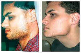 men s laser hair removal las vegas