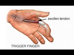 Numbness in the fingers and hand can have a variety of different causes, including a pinched nerve, medications, and myofascial pain syndrome. Trigger Finger Youtube