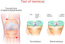 does a meniscus tear mean surgery