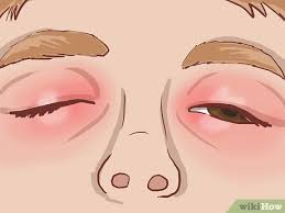 how to treat eczema around the eyes