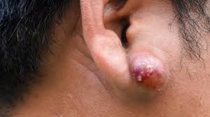 what causes lumps behind the ears