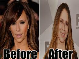 jennifer love hewitt plastic surgery