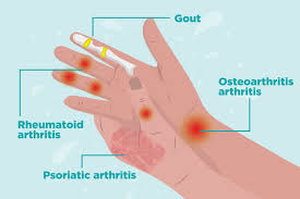 Women are more likely than men to have arthritis in their hands, and often people experience arthritis symptoms in their hands before other signs of arthritis show up. Arthritis In Hands Symptoms Types Of Hand Arthritis And Treatment