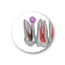 Eine wurzelspitzenresektion kann nötig werden, wenn eine wurzelbehandlung bei zähnen aus verschiedenen gründen nicht erfolgreich war. Wurzelspitzenresektion Bad Sackingen Praxis Dr Dr Dippel