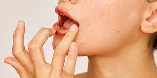 dry skin around your mouth