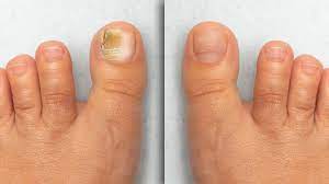 nail conditions ny hudson dermatology
