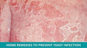 how to prevent yeast infection through