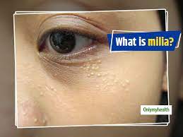 milia ways to get rid of these white spots