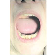 clinical case no 1 normal mouth