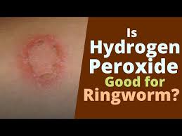 faq can peroxide get rid of ringworm