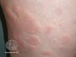 allergy rashes images symptoms treatment