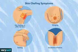 chafing causes treatment and prevention