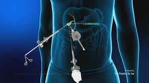 laparoscopic gallbladder surgery video