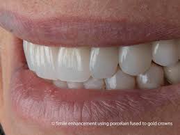 Porcelain Fused To Metal Crowns Quality Levels Of Pfm Crowns