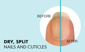 dry split nails and cuticles depend