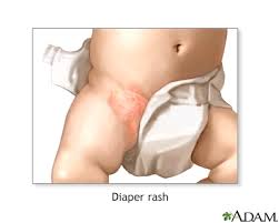 diaper rash information mount sinai