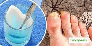 home remes for sore cuticles
