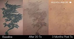 laser tattoo removal toronto see