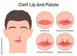 stockvector cleft lip and cleft palate