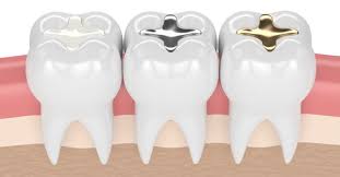 Dental filling costs without insurance can vary. Tooth Filling Procedure Cost Cavity Filling Types Nearby Dental