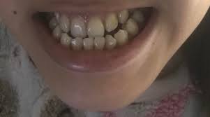 To correct underbites, just about every oral surgeon and orthodontist recommends braces first, jaw surgery second and braces. I Have An Underbite That Looks Like This Is It Possible That Braces Can Treat It Without Jaw Surgery Braces