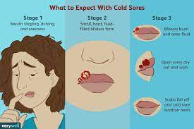 ses of a cold sore outbreak on lips