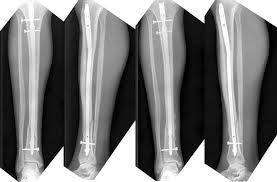 locked nailing in tibial fractures