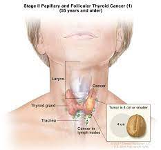 There are several thyroid cancer types with different treatments. Thyroid Cancer Treatment Adult Pdq Patient Version National Cancer Institute
