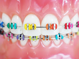 If you're new to wearing if your braces are hurting you or you're looking for ways to get rid of braces pain, you've come to the right place! Answers To Common Questions About Orthodontics Part 2 All About The Rubber Bands