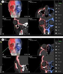 surgical navigation