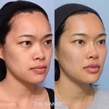 That's why you should only. Asian Face Injectables And Laser Best Clinic Sydney For Dermal Fillers