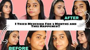 cream for acne scars mederma review