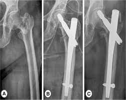 gamma nail and the dynamic hip