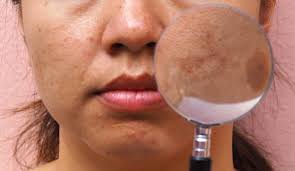 how to recognize and treat melasma