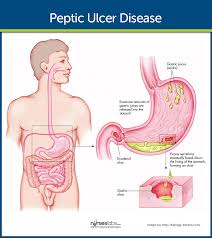 Peptic Ulcer Disease Nursing Care And Management Nurseslabs