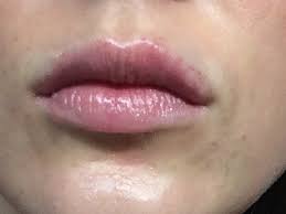 white patch normal after lip fillers