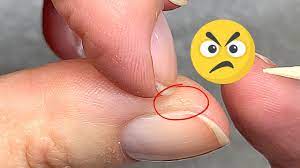 hard annoying skin around the nails 2
